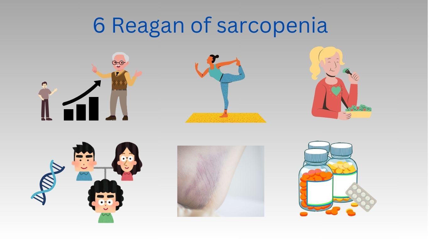 6 Reagan of sarcopenia